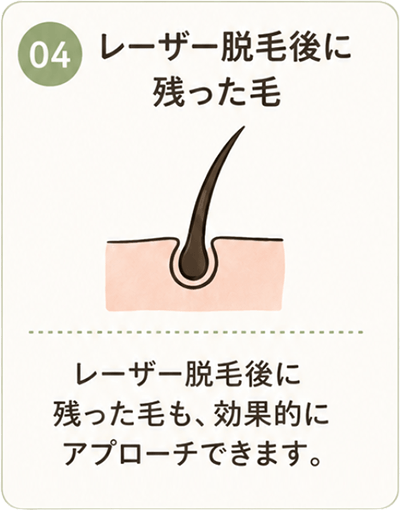 04 レーザー脱毛後に残った毛